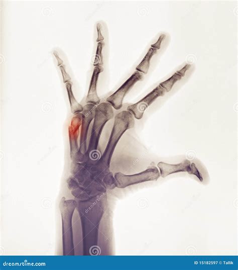 Hand X-ray Showing A Boxer's Fracture Royalty Free Stock Photography - Image: 15182597