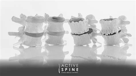 Conoces la discopatía degenerativa Active Spine