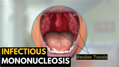 Infectious Mononucleosis Causes Signs And Symptoms Diagnosis And