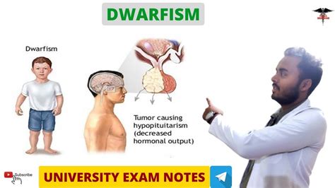 Hypopituitarism Dwarfism