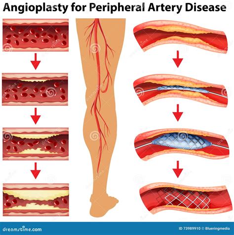 Leg Artery Disease, Atherosclerosis Vector Illustration | CartoonDealer