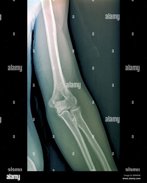 Normal Elbow Joint X Ray Stock Photo Alamy