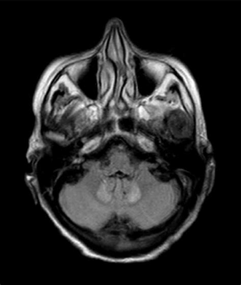 IRM cérébrale Coupe axiale Séquence en FLAIR Download Scientific