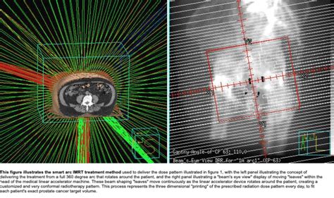 Igrt Imrt For Prostate Cancer Unio Specialty Care
