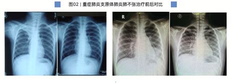 健康科普丨支原体肺炎14天病程用药图来了！腾讯新闻