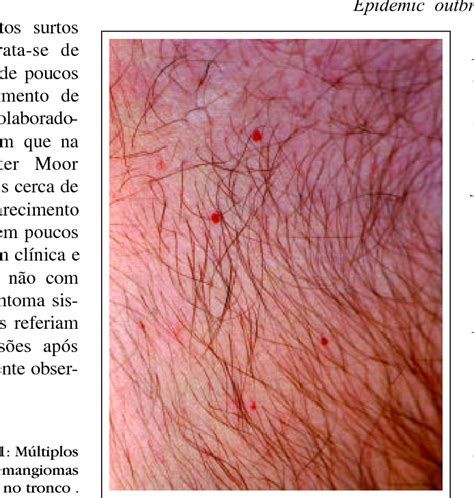 Figure From Cherry Hemangioma In The Scalp Semantic Scholar