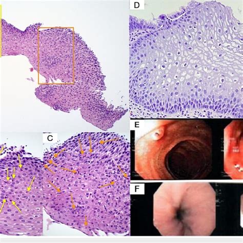 Esophageal Pathology And Endoscopy Pathology Slides Of The Patients