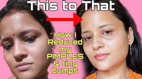 How I Reduced My PIMPLES Tiny Bumps Naturally Sirf 30 Din Mien Gayab