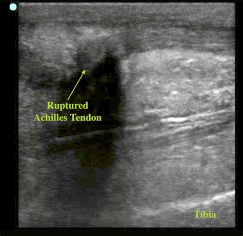 Torn Achilles Tendon Ultrasound