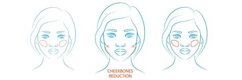 Cheekbone Reduction - Medical Help Turkey