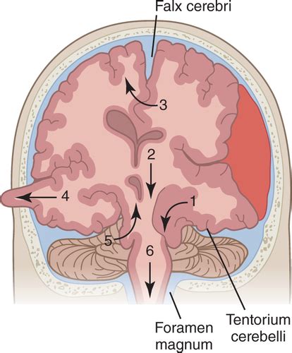 Increased Intracranial Pressure Flashcards Quizlet