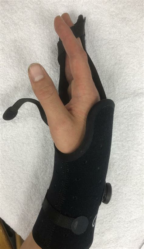 Metacarpal Fracture Treatment Melbourne Gippsland