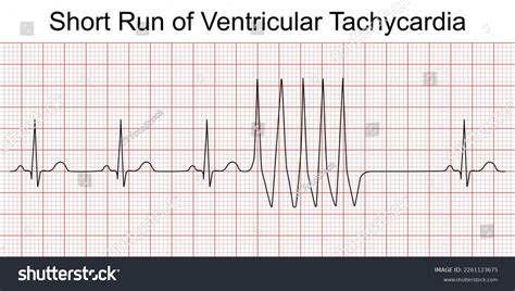 Ventricular Fibrillation Vs Ventricular Tachycardia Ecg