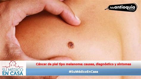 Sumédicoencasa Cáncer De Piel Tipo Melanoma Causas Diagnóstico Y