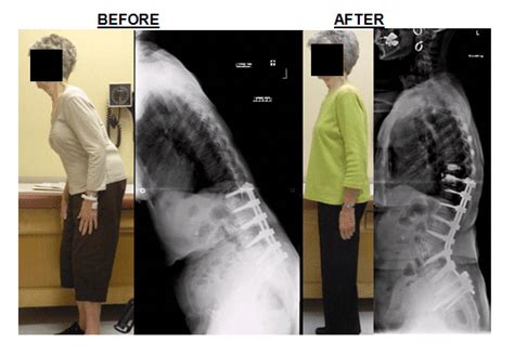 What is Flatback Syndrome?: Restore Orthopedics and Spine Center ...