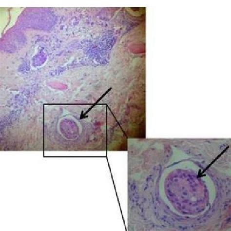 Tissue Section Of Inflammatory Breast Cancer Case Enrolled In Our Study