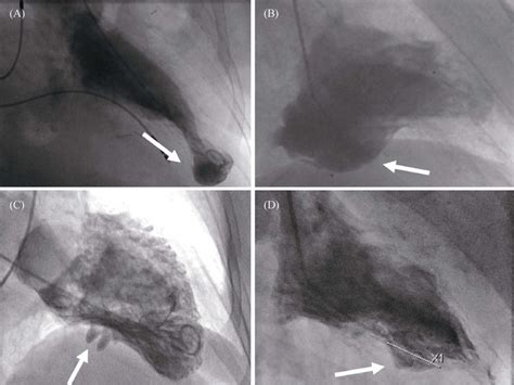 Left Ventricular Angiography A Apical Diverticulum B