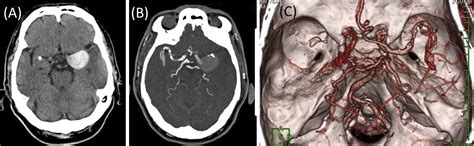 Cerebral Aneurysm Ct