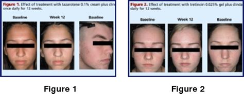 Tazarotene 01 Percent Cream Plus Clindamycin 1 Percent Gel Versus