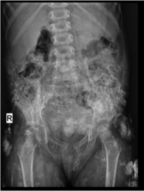 Bisphosphonate Therapy For Juvenile Dermatomyositis Associated