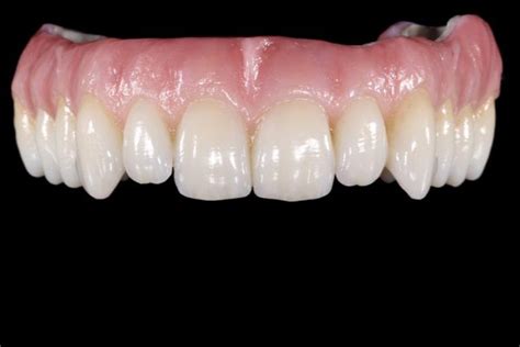 Nuevas Gu As De Colores De Zirconia Monol Tica Prettau Noticias Dentales