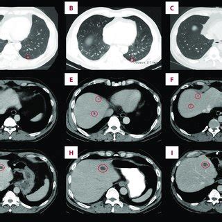 Thoracic And Abdominal Contrast Enhanced Computed Tomography Ct Scans