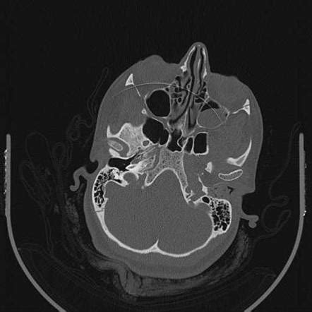 External Auditory Canal Cholesteatoma Radiology Case Radiopaedia Org