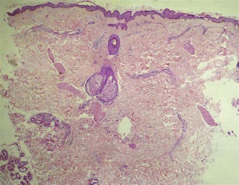 SciELO Brasil Dermatoscopic Findings In Telangiectasia Macularis