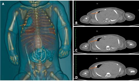 Results Of Imaging Examination A Total Body Postmortem Computed