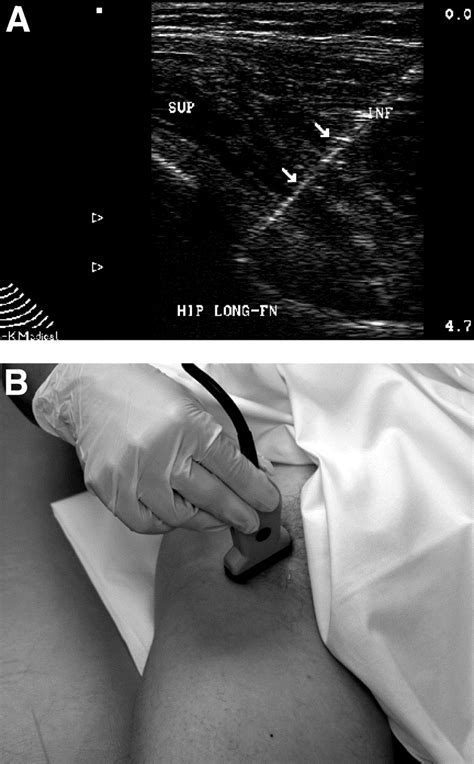 Office Based Ultrasound Guided Intra Articular Hip Injection Technique