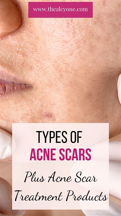 Types of acne scars and treatment products – Artofit