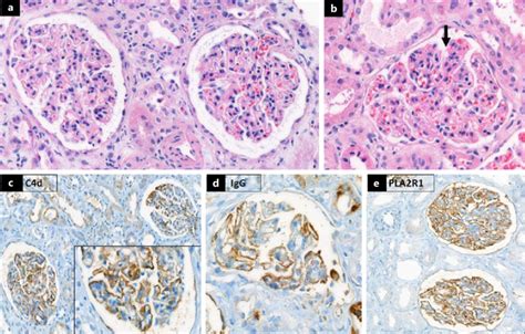 Diffuse Capillary Wall Thickening And Mild Mesangial Proliferation In