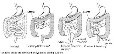 Types of Bowel Diversion Surgery | Common Digestive Disorders