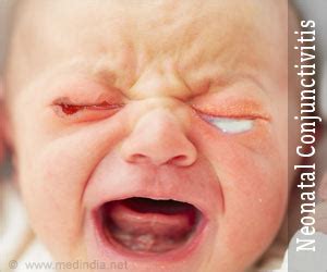 Neonatal Conjunctivitis - Causes, Symptoms, Diagnosis, Treatment ...