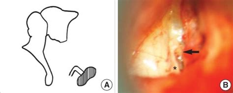 Stapes footplate fixation with monopolar crus and without incus long ...