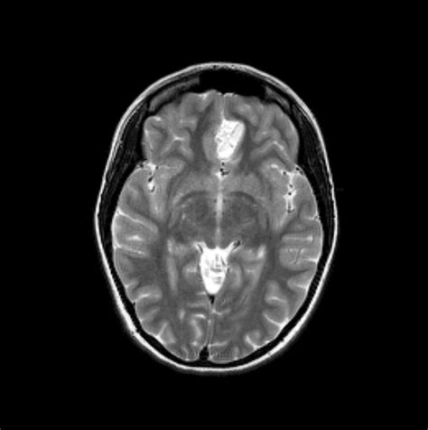 Ruptured Intracranial Dermoid Image