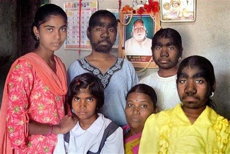 3 Indian Sisters Suffering From Rare Werewolf Syndrome Photos Niger Times Test Site