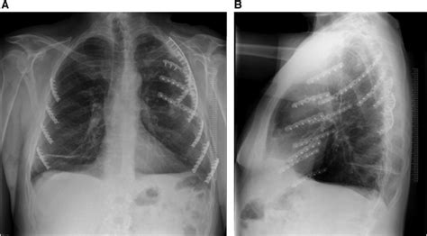 Anteriorposterior Ap And Lateral Chest Radiographs Showing The Ribs