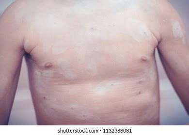 Chickenpox Treatment Antiseptic Cream Unrecognizable Kid Stock Photo 1132388081 | Shutterstock