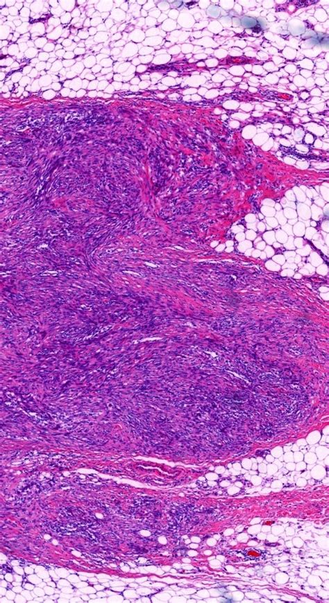 Pathology Of Nodular Fasciitis Pathology