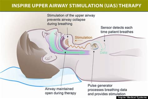 Mild Electronic Stimulation Therapy Effective For Sleep Apnea Study