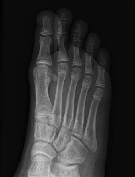 Normal Apophysis Of The Proximal 5th Metatarsal Image