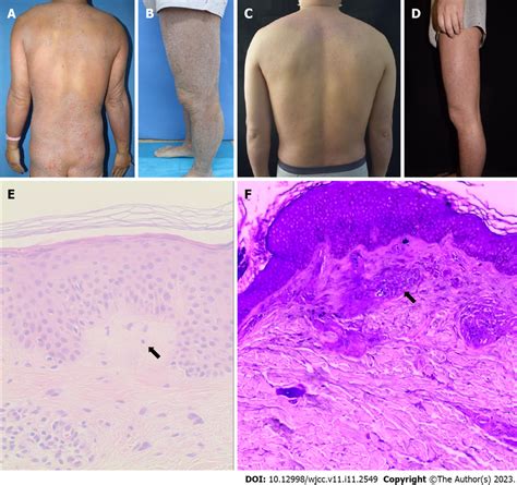 Case 1 A And B Dense Hard Brown Plaques Were Seen On The Trunk And