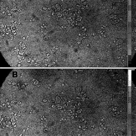 Chemiluminescence In Situ Hybridization Revealing The Presence Of CMV