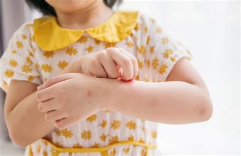 6 Tips Mengatasi Biang Keringat Pada Bayi Dan Anak Ulasan Co