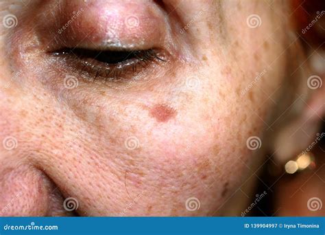 Pigmentation on the Face. Brown Spot on Cheek. Pigment Spot on the Skin ...