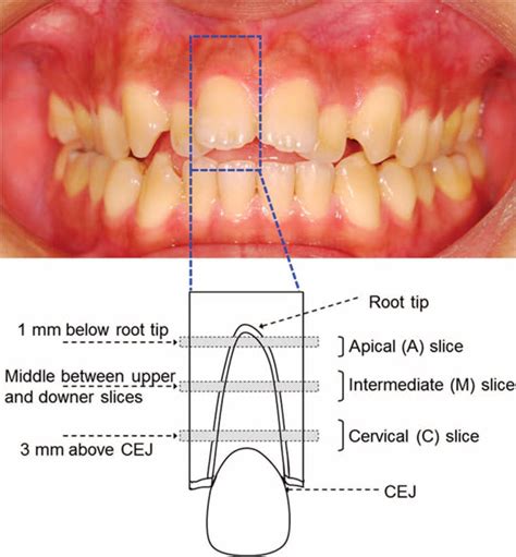 Schematic Of The Levels At Which The Root Of The Upper Right Lateral