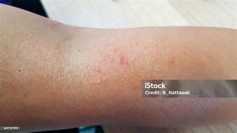 Close Up Many Rash On Arm Or Human Skin Selective Focus Rashes May