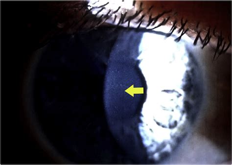 Slit Lamp Photography Of Stage Ii Diffuse Lamellar Keratitis 12 Days Download Scientific