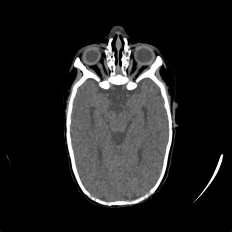 sagittal craniosynostosis - Skull, Head, and Neck CTs - embodi3D.com